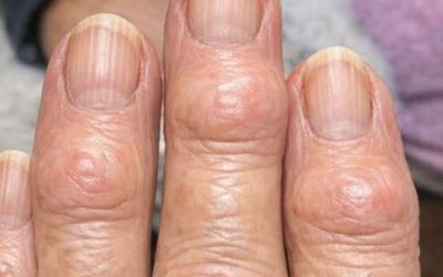 Mijn oma heeft harde bultjes op haar vingergewrichten, vlakbij haar nagels. Waarom breidt dit zich uit? Volledig artikel 👇 💬