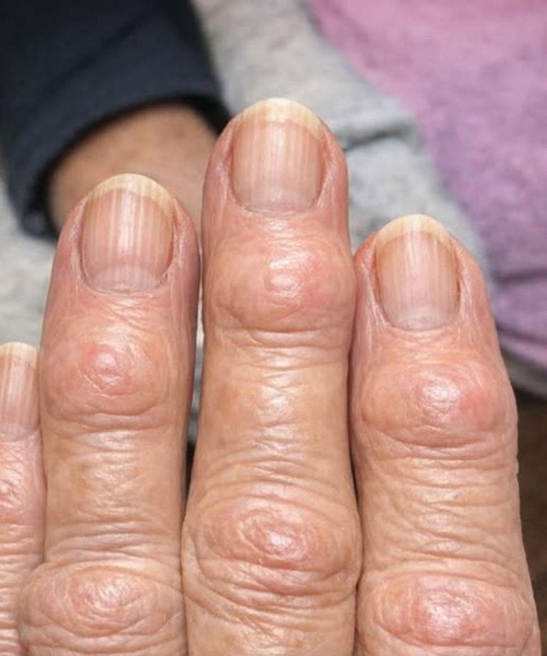 Mijn oma heeft harde bultjes op haar vingergewrichten, vlakbij haar nagels. Waarom breidt dit zich uit? Volledig artikel 👇 💬