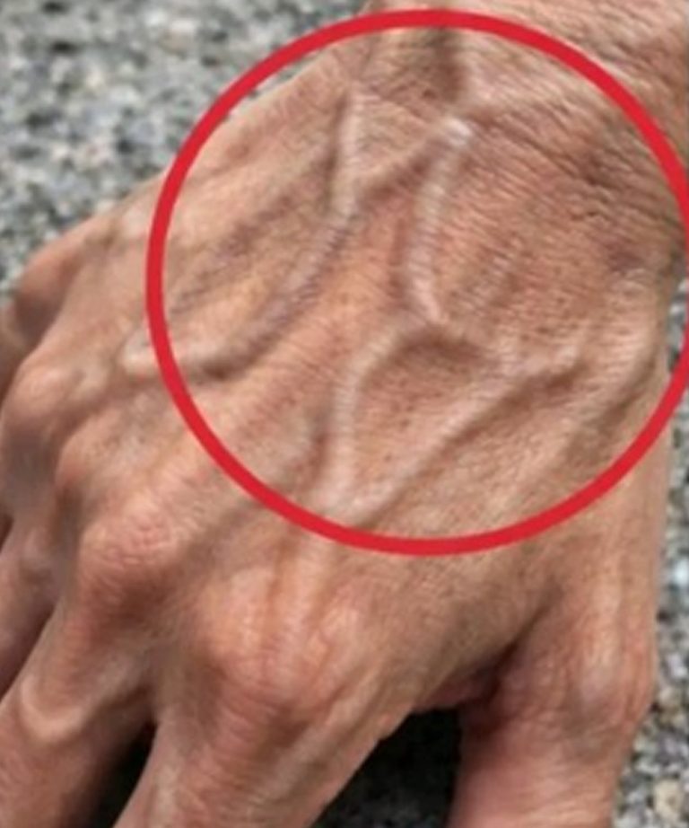Als de aderen in je hand zichtbaar zijn, is dat een teken van…