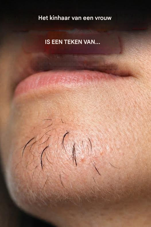 Kinhaar bij vrouwen is een teken van… Meer weergeven