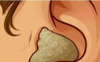 8 zachte en veilige oplossingen om afscheid te nemen van Earwax-accumulatie